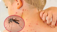 Dịch sốt xuất huyết nóng từng ngày, các địa phương 'khóc ròng' vì thiếu thuốc