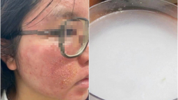 Bôi kem đánh răng, nước vôi lên mặt trị mụn, cô gái 21 tuổi cầu cứu bác sĩ