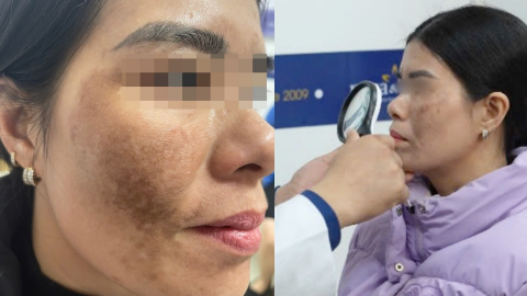 Trị nám để chuẩn bị đón Tết tại spa gần nhà, người phụ nữ bỏng toàn bộ khuôn mặt