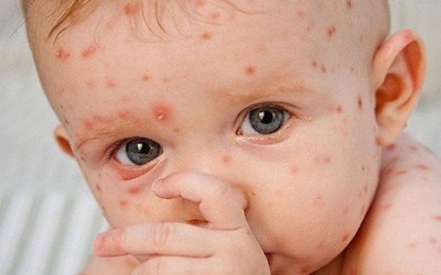 Bùng phát dịch sởi tại Mỹ, CDC ban bố cảnh báo đi lại