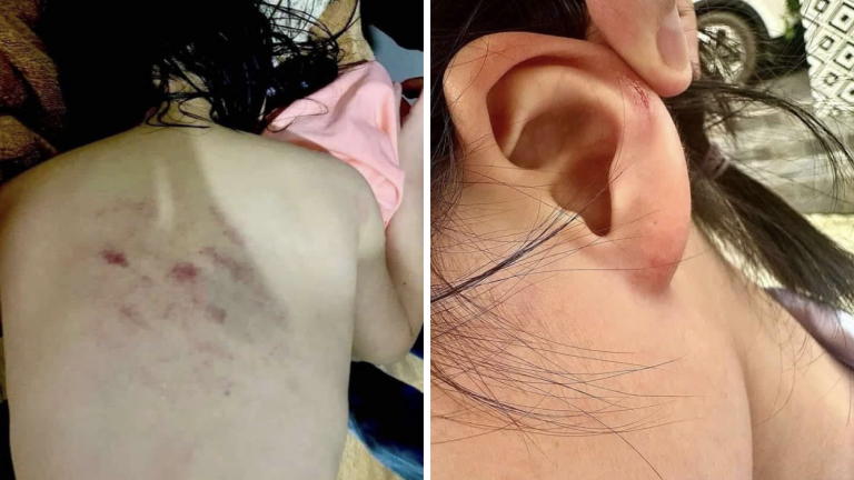 Cô giáo xoắn rách tai, đập lưng học sinh lớp 1 thâm tím: Đã có quyết định kỷ luật
