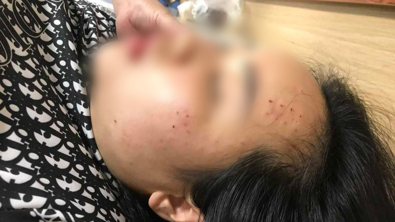 Cô gái sốc vì bị tiêm nhầm sữa rửa mặt vào da khi đi làm đẹp tại spa