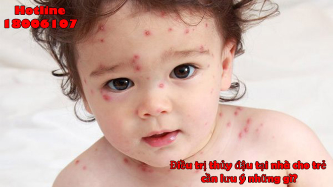 Bệnh thủy đậu thường phổ biến ở trẻ em. Bệnh thủy đậu thường phổ biến ở trẻ em.