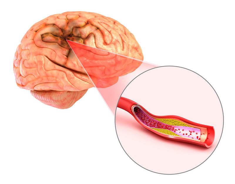 Đột quỵ não và vai trò của chụp cộng hưởng từ (MRI) trong tầm soát đột quỵ - Ảnh 1.