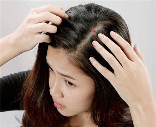 5 nốt ruồi ẩn chứa tài lộc, vượng vận quý nhân, 10 người có thì 9 người giàu sang, sung túc - Ảnh 1.