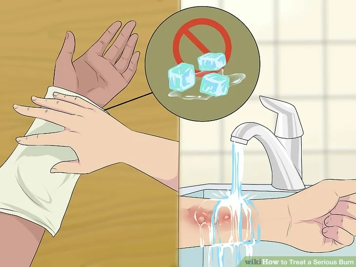 Bé gái bỏng hóa chất &quot;tẩy dầu mỡ&quot;, bác sĩ mách cách sơ cứu chính xác - Ảnh 3.