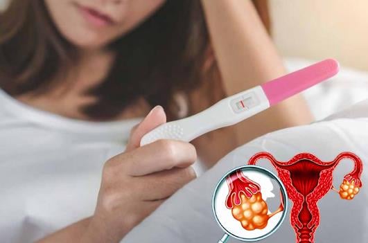 Dấu hiệu u nang buồng trứng và giải pháp cải thiện hiệu quả từ Nga Phụ Khang - Ảnh 2.