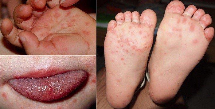 Cách phòng bệnh tay chân miệng ở trẻ và giải pháp ưu việt từ cốm Subạc - Ảnh 2.