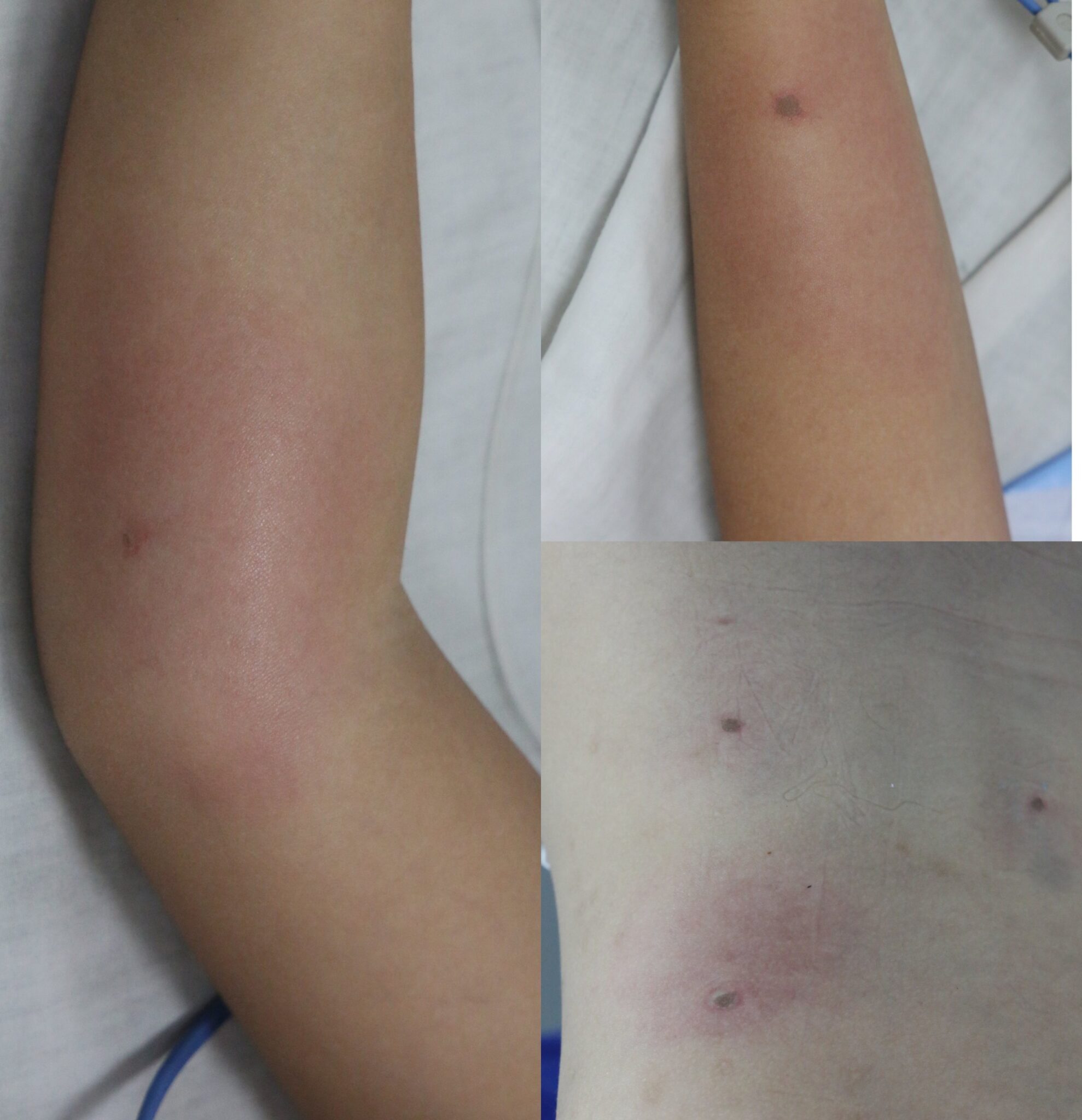 Trẻ bị sốc phản vệ, suy đa tạng nguy hiểm do bị ong đốt - Ảnh 2.