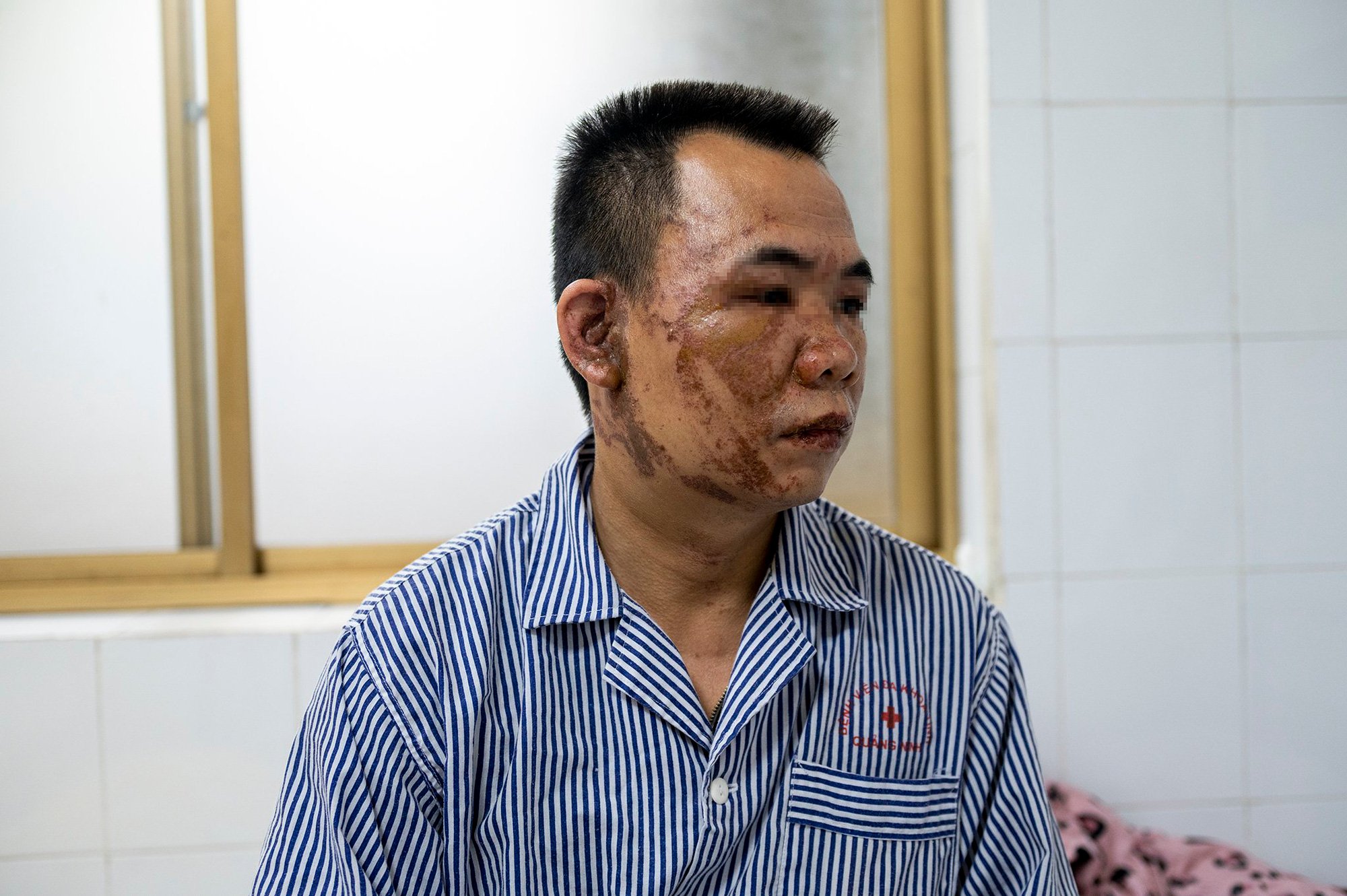 Lời kể của người đàn ông bị tạt axit sau cuộc cãi vã - Ảnh 1.