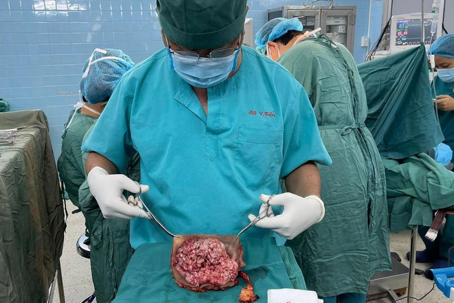 Tự đắp lá vùng kín, người phụ nữ gánh khối u khổng lồ - Ảnh 1.