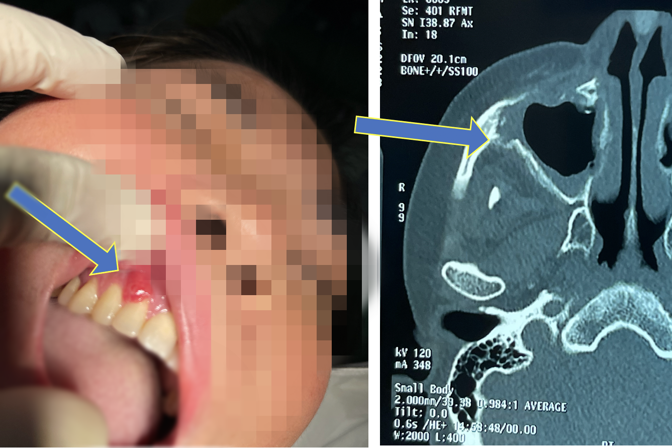 Bí ẩn nhiều người phải mổ não, mất mạng vì hoại tử xương sọ &quot;hậu Covid-19&quot; - Ảnh 3.