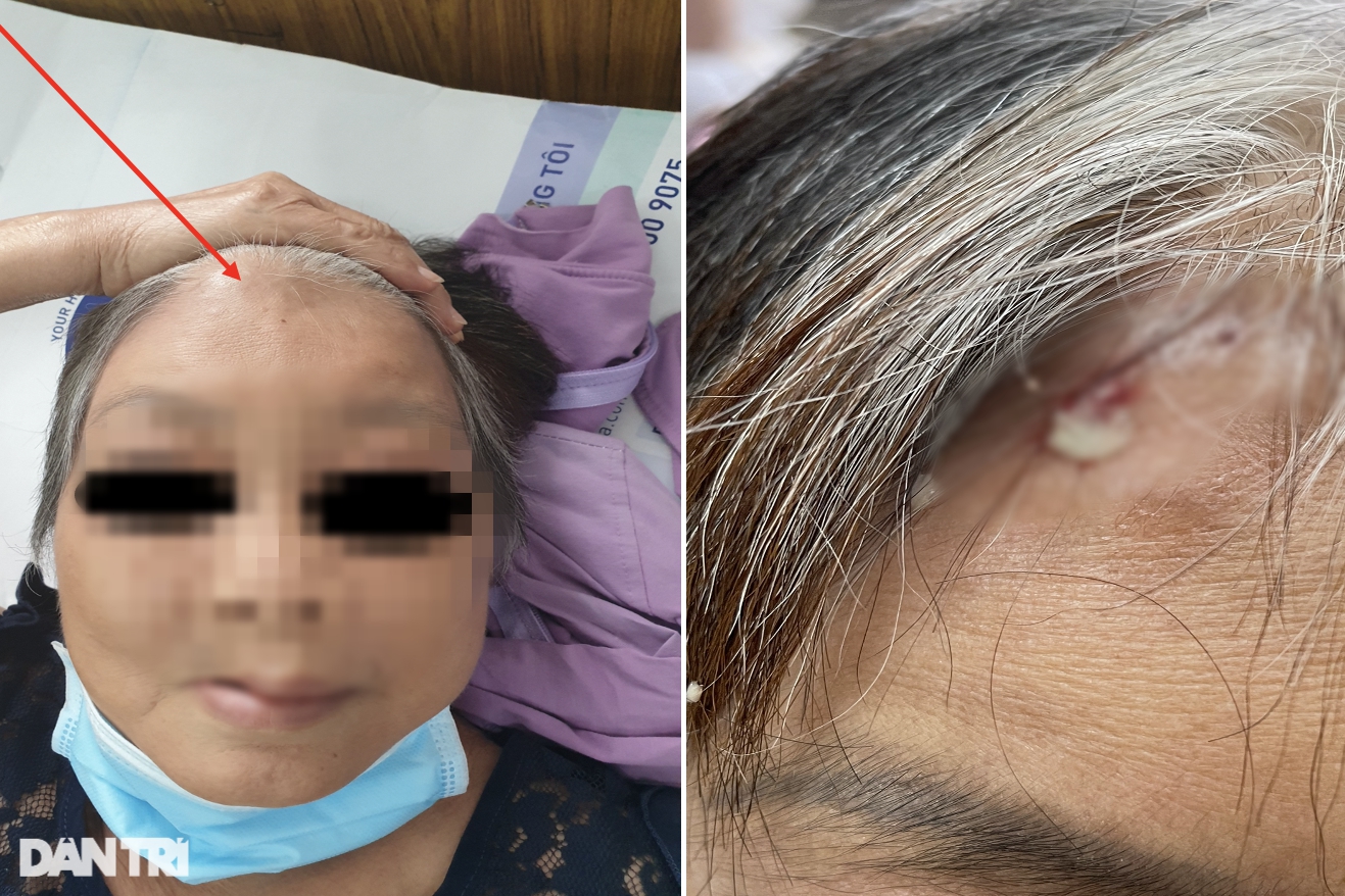 Bí ẩn nhiều người phải mổ não, mất mạng vì hoại tử xương sọ &quot;hậu Covid-19&quot; - Ảnh 2.