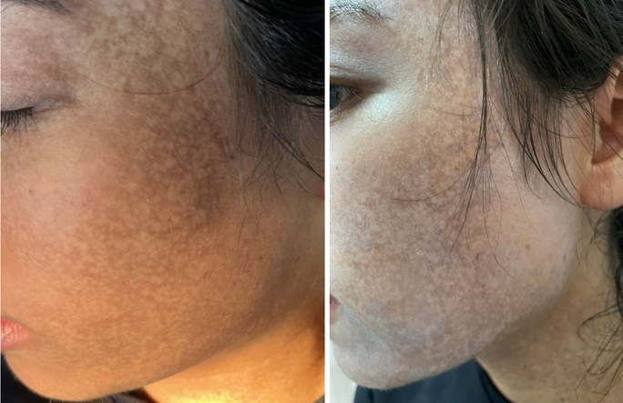Đến spa &quot;lột da&quot; trị nám, làm trắng, mặt của cô gái đen sạm, khó phục hồi - Ảnh 1.