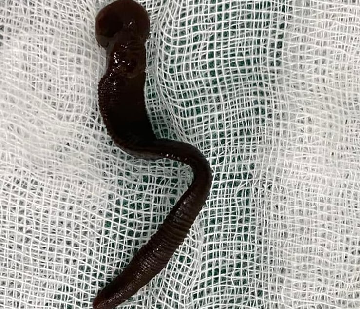 Con đỉa dài 8 cm nằm trong khí quản suốt 1 tháng, gây viêm loét đường thở  - Ảnh 1.