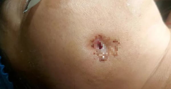 Hy hữu: Răng khôn mọc lệch đâm thủng má vẫn nghĩ là... mụn - Ảnh 1.