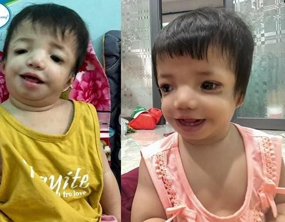 &quot;Tìm lại&quot; gương mặt cho bé gái 10 tháng tuổi bị dị tật sọ mặt hiếm gặp - Ảnh 3.