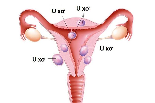Cách chữa u xơ tử cung và giải pháp cải thiện bệnh từ Nga Phụ Khang - Ảnh 1.
