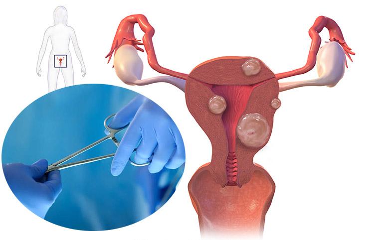 Cách chữa u xơ tử cung và giải pháp cải thiện bệnh từ Nga Phụ Khang - Ảnh 3.