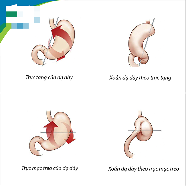 Đau bụng dữ dội, nôn khan, bé gái 3 tuổi bị xoắn dạ dày hiếm gặp - Ảnh 2. Đau bụng dữ dội, nôn khan, bé gái 3 tuổi bị xoắn dạ dày hiếm gặp - Ảnh 2.