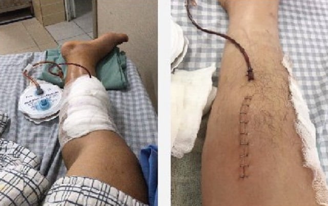 Thanh niên suýt mất chân vì tự ý dùng thuốc Đông- Tây y chữa bệnh khớp - Ảnh 1.
