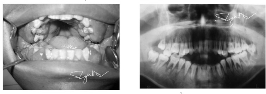 Đi khám vì viêm lợi cấp, thiếu niên 16 tuổi phát hiện bị u máu ác tính - Ảnh 1.