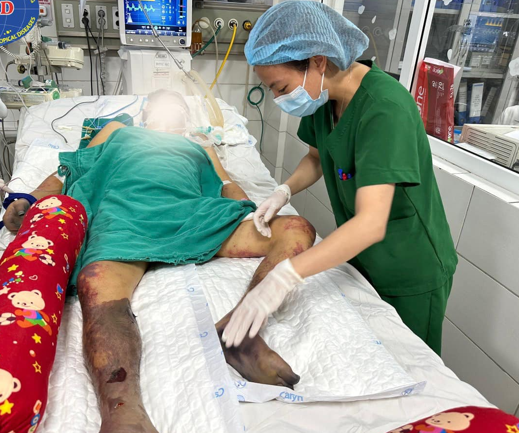Ăn 1 miếng dồi lợn, người đàn ông mắc liên cầu lợn, phải cắt bỏ 2 bàn chân và một phần bàn tay - Ảnh 2.