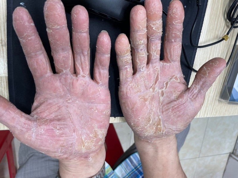 Tin lời đắp nhựa cây xương rồng chữa viêm da như &quot;thần dược&quot; trên mạng xã hội, người đàn ông nhận cái kết đắng - Ảnh 1.