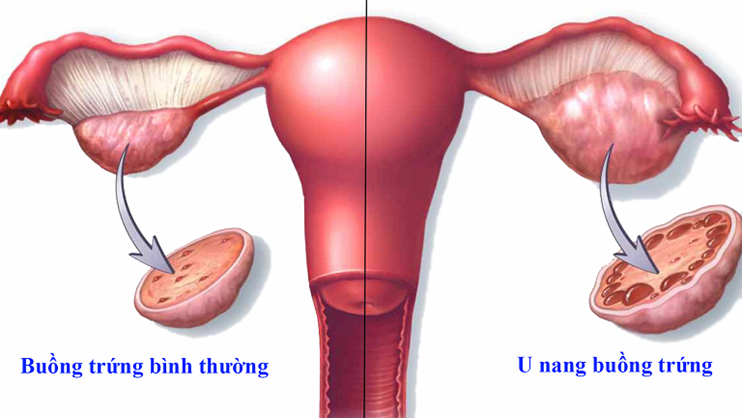 Nga Phụ Khang - Giải pháp hỗ trợ điều trị u nang buồng trứng hiệu quả, an toàn từ thảo dược - Ảnh 1.