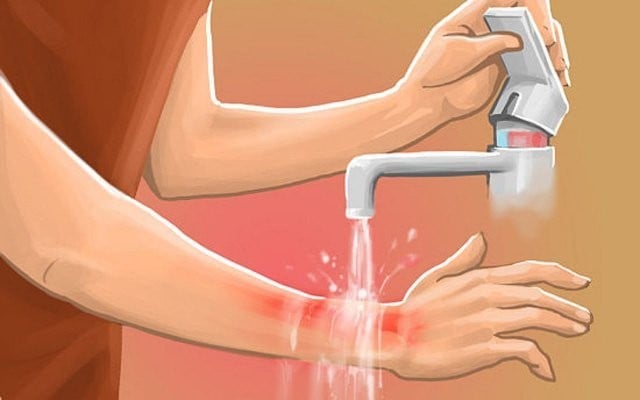 Xử trí khi bị bỏng pô xe máy - Ảnh 2.