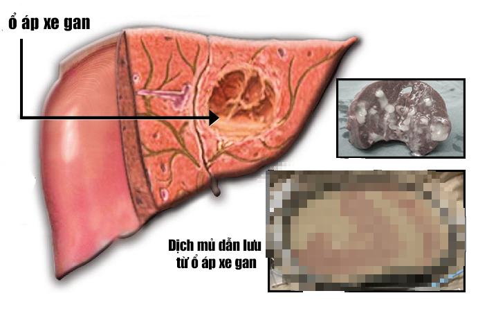 Sụt cân nhanh, sốt kéo dài hóa ra áp xe gan nghiêm trọng - Ảnh 1.