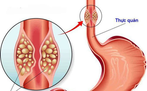 Đau rát họng, nuốt khó tưởng viêm họng hóa ra ung thư thực quản - Ảnh 1.