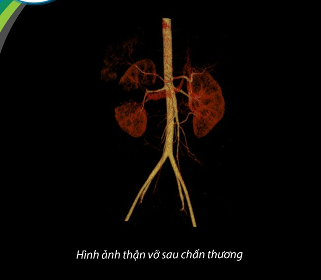 Trẻ ngã tưởng đau nhẹ chỉ xoa dầu, hóa ra vỡ thận - Ảnh 1.