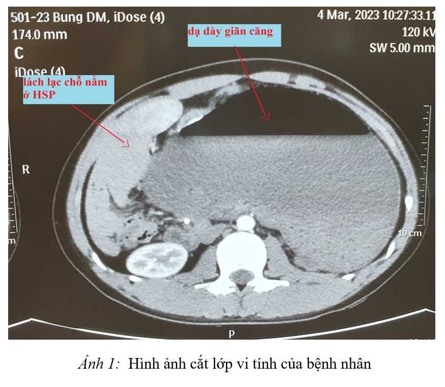 Xoắn dạ dày khiến thanh niên đau chướng bụng, buồn nôn nhiều ngày - Ảnh 1.