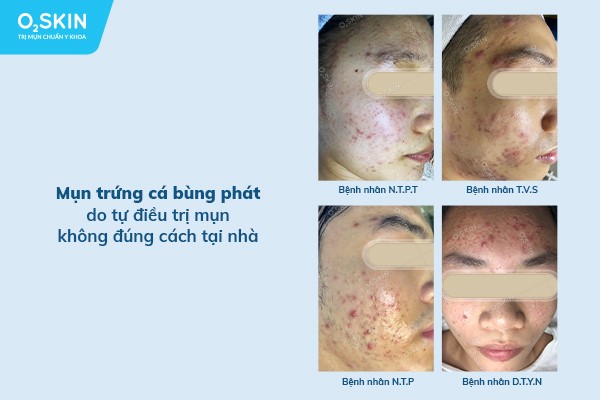 Tự trị mụn, tưởng rẻ mà không rẻ - Ảnh 1.