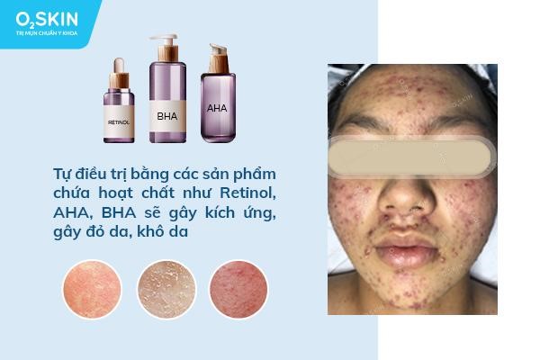 Tự trị mụn, tưởng rẻ mà không rẻ - Ảnh 2.