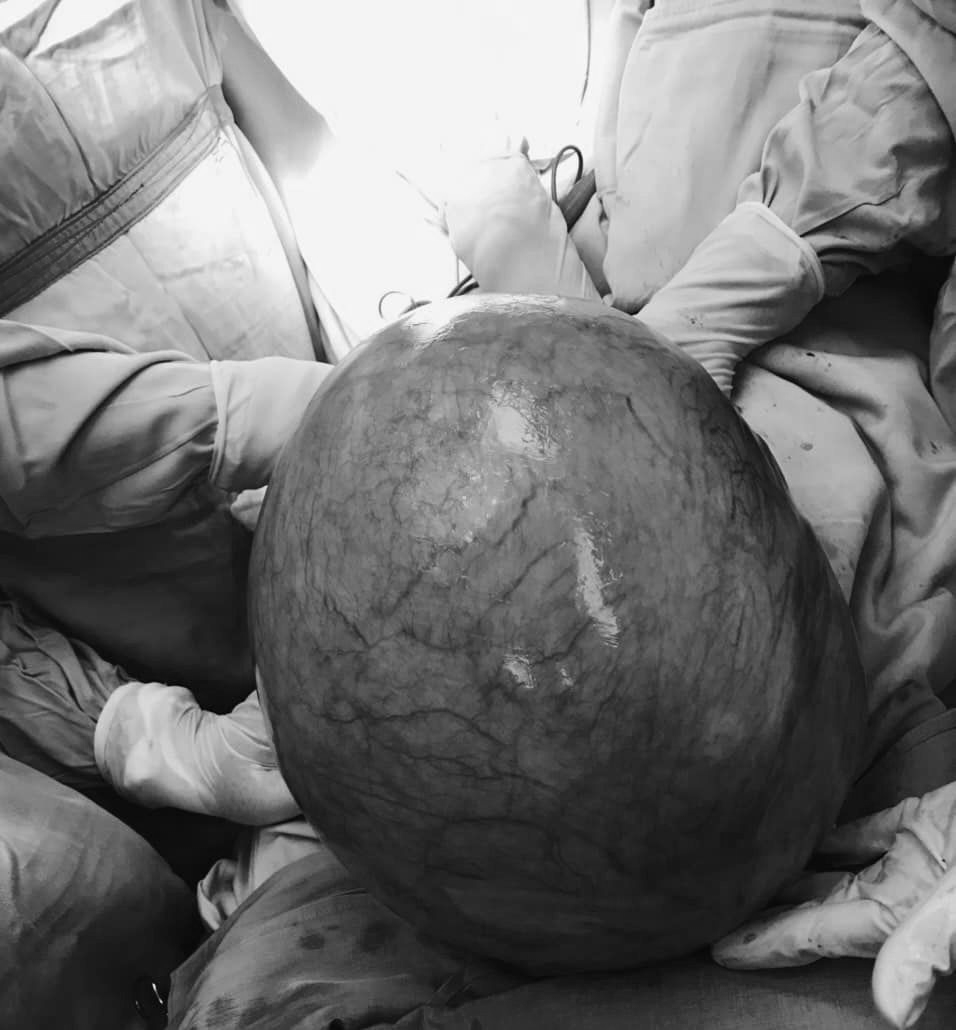 Ngỡ ngàng với khối u tử cung khủng nặng 10kg, bệnh nhân chỉ nghĩ... béo bụng - Ảnh 2.