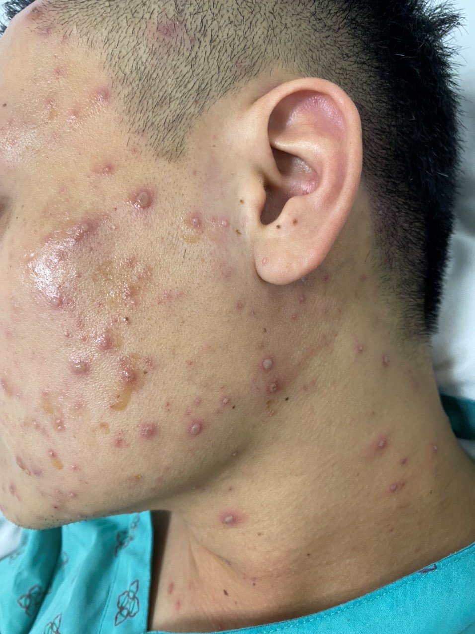 Sốt cao, đau đầu, nổi nhiều nốt đỏ coi chừng mắc bệnh thủy đậu - Ảnh 1.