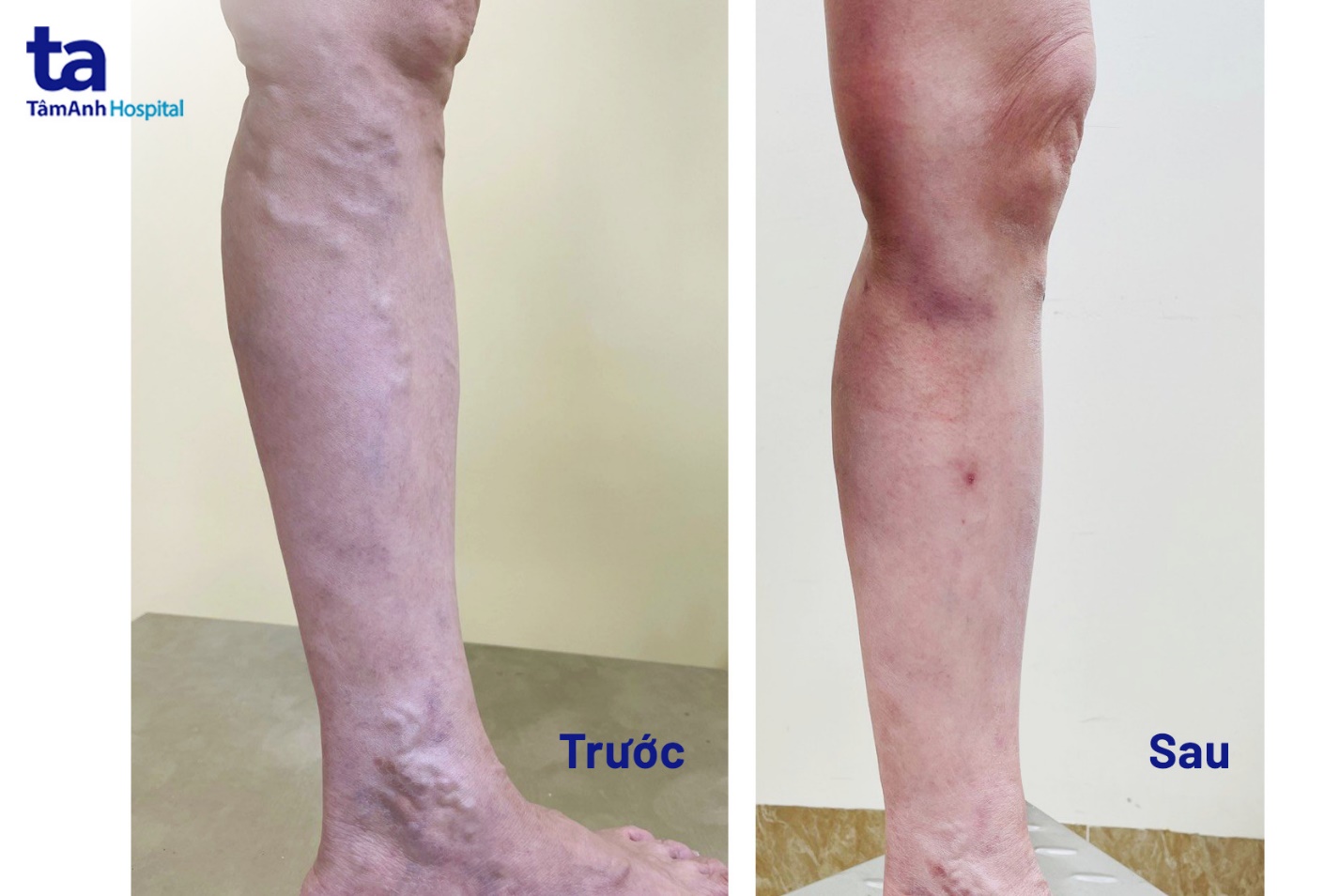 Bệnh viện Tâm Anh điều trị triệt để suy giãn tĩnh mạch chân cho bệnh nhân bằng phương pháp Laser nội mạch - Ảnh 1.