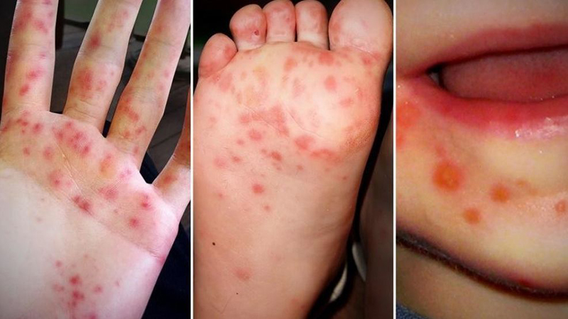 Bệnh tay chân miệng đang vào mùa, bác sĩ cảnh báo dấu hiệu bệnh nặng phải nhập viện - Ảnh 1.