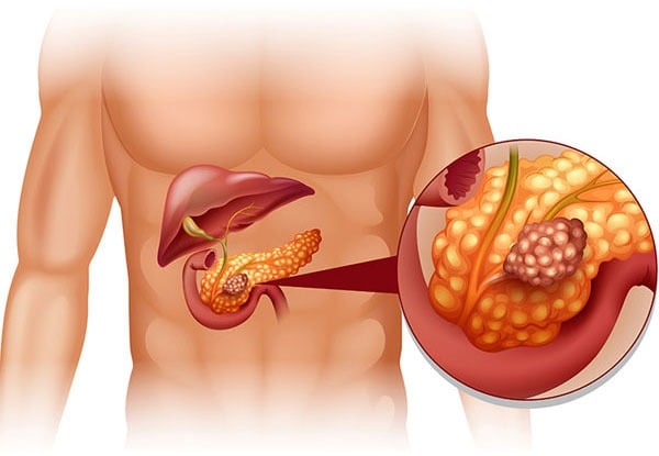 Nam thanh niên, viêm tụy mạn, ung thư tụy sau 22 năm nghiện rượu, hút thuốc lá - Ảnh 2.