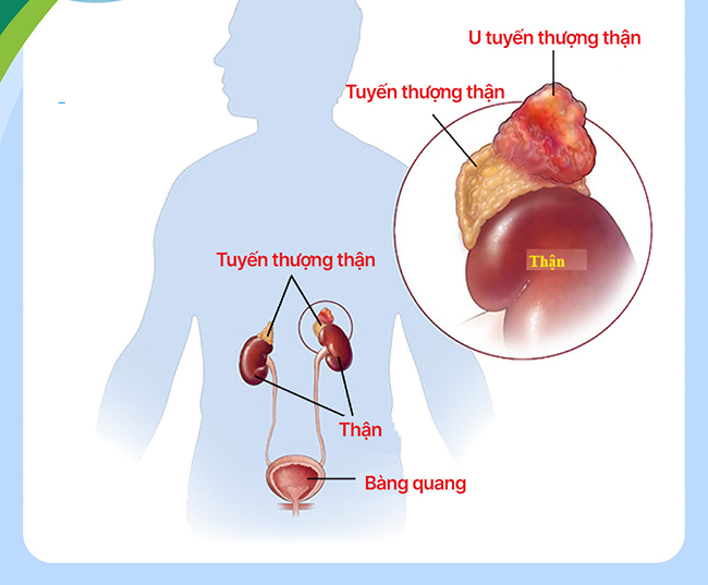 14 tuổi đã bị cao huyết áp, nào ngờ bị u tuyến thượng thận 2 bên hiếm gặp - Ảnh 1.