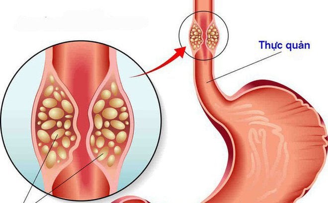 Phó Chủ tịch Hội ung thư: Hai thứ hay sử dụng làm cho &quot;cánh mày râu&quot; dễ bị ung thư thực quản - Ảnh 2.