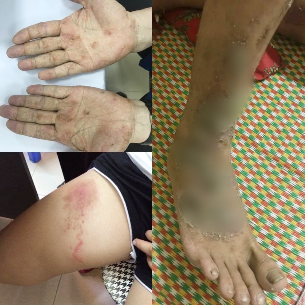 Kinh hãi ấu trùng giun đũa chó mèo làm tổ dưới da suốt nhiều năm vì thói quen này  - Ảnh 1.