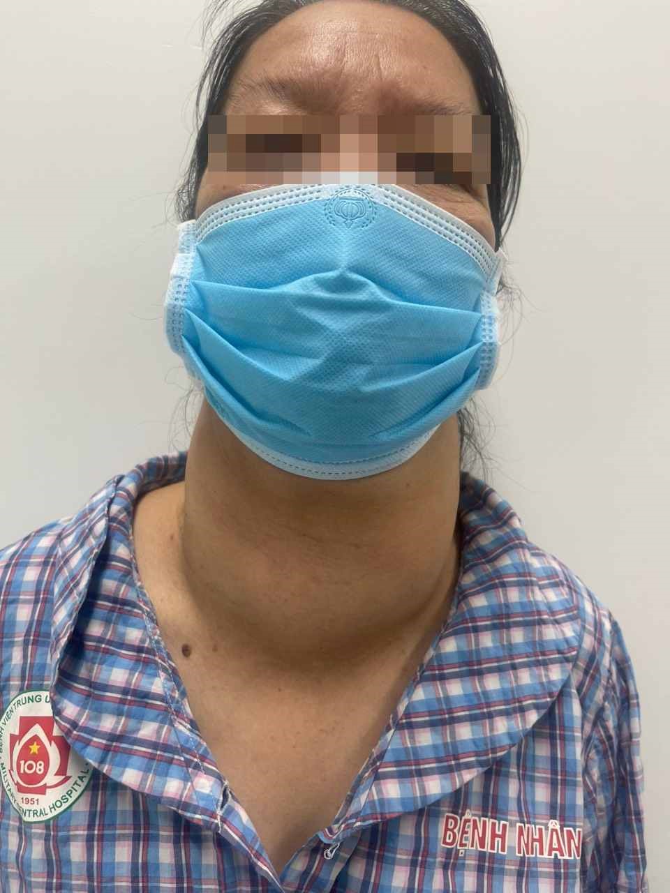 Phẫu thuật thành công khối u tuyến giáp khổng lồ - Ảnh 2.