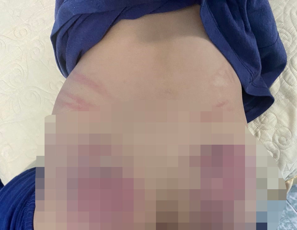 Lời kể mẹ bé trai 9 tuổi chậm phát triển nghi bị cô giáo bạo hành - Ảnh 1.