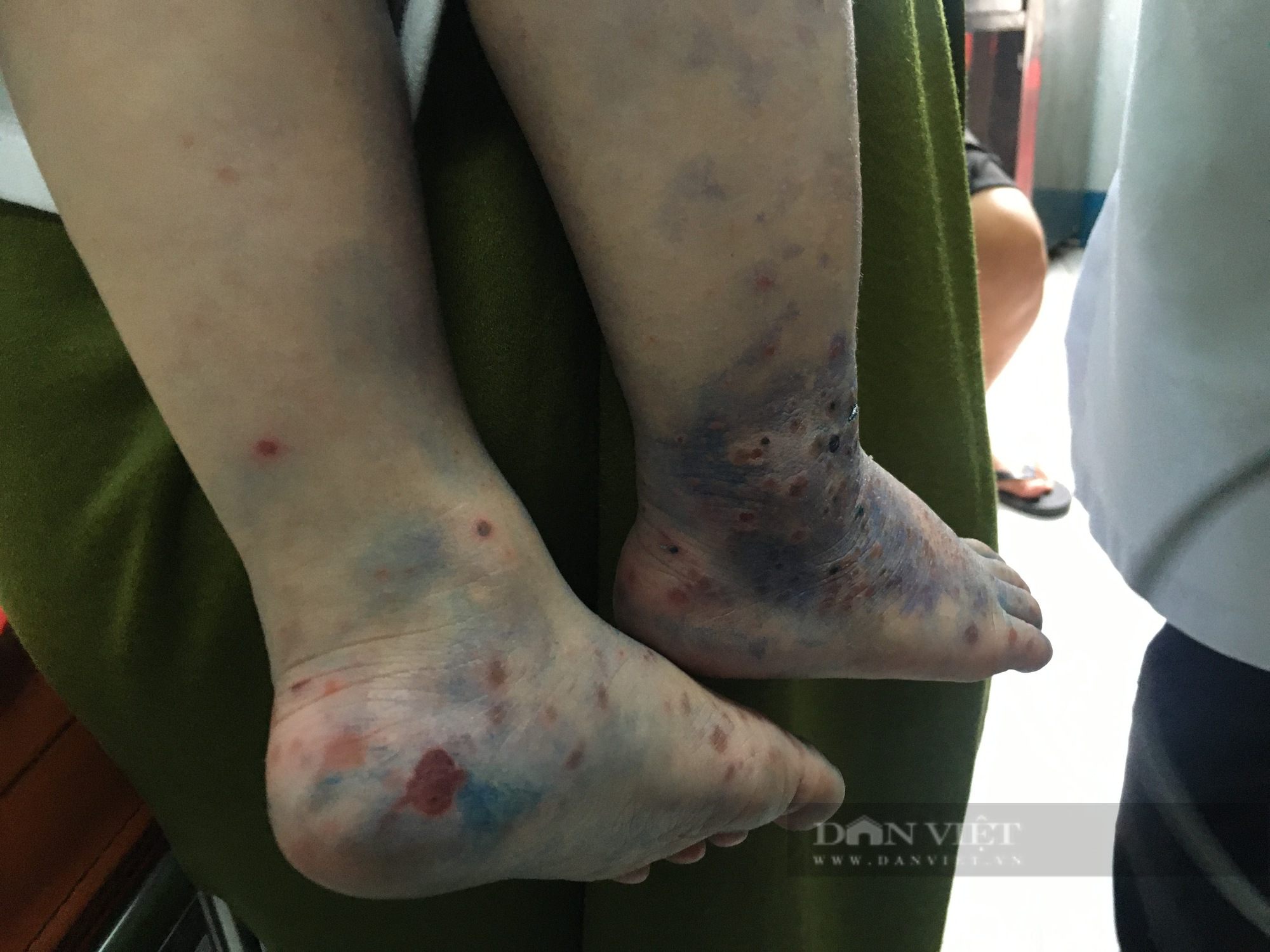TP.HCM: Xác định chủng virus gây bệnh tay chân miệng nặng, lo ngại dịch chồng dịch - Ảnh 3.