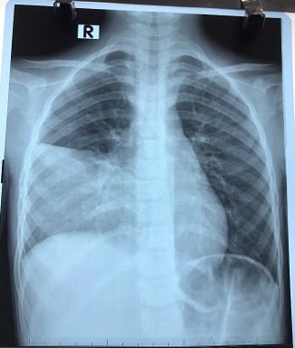 Cảnh giác với bệnh viêm phổi do vi khuẩn, dễ lây, biến chứng nguy hiểm - Ảnh 2.
