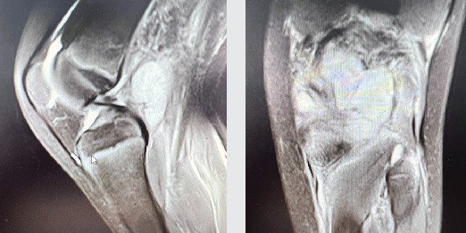 Đắp thuốc nam không rõ nguồn gốc chữa nhọt, 1 cậu bé có nguy cơ đi lại khó khăn - Ảnh 1.
