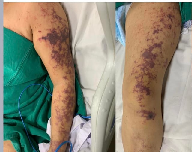 Tại sao không ăn tiết canh, đồ tái vẫn có người người bị nhiễm khuẩn liên cầu lợn? - Ảnh 2.